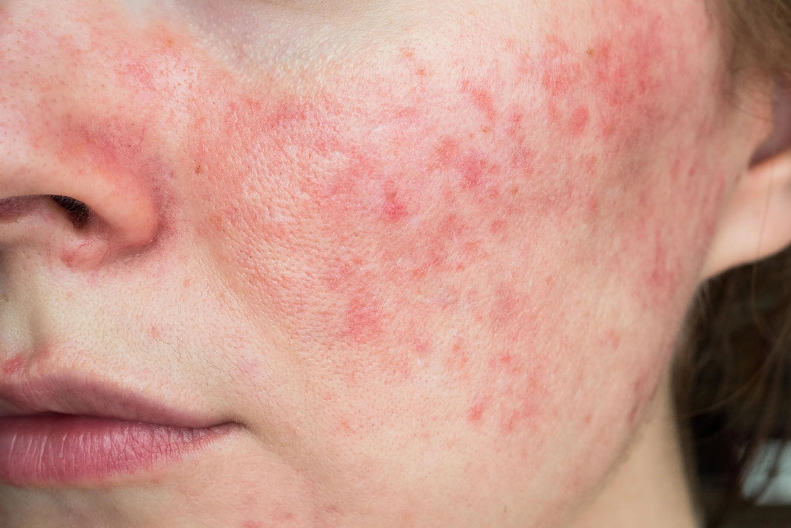 What is ROSACEA?